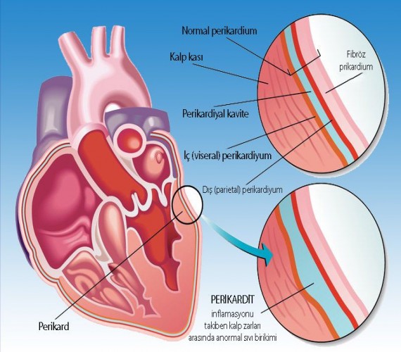 Kalp Zarı Hastalıkları