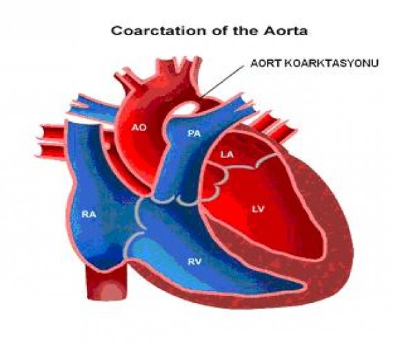 Aort Koarktasyonu