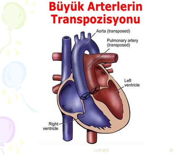 Büyük Arter Transpozisyonu